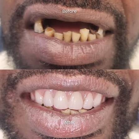 Complete smile makeover before and after result
